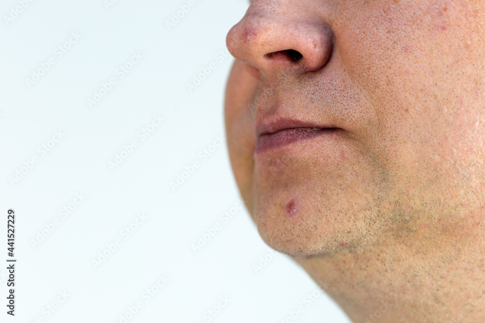 Fototapeta premium Male face with pimples on nose and chin close up.