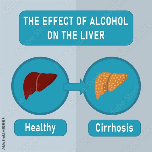 The effect of alcohol on the liver. Vector illustration