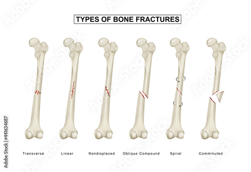 Murais de parede Types of bone fractures. Femoral Shaft fracture