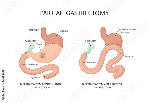 Partial gastrectomy. Stomach cancer, tumor