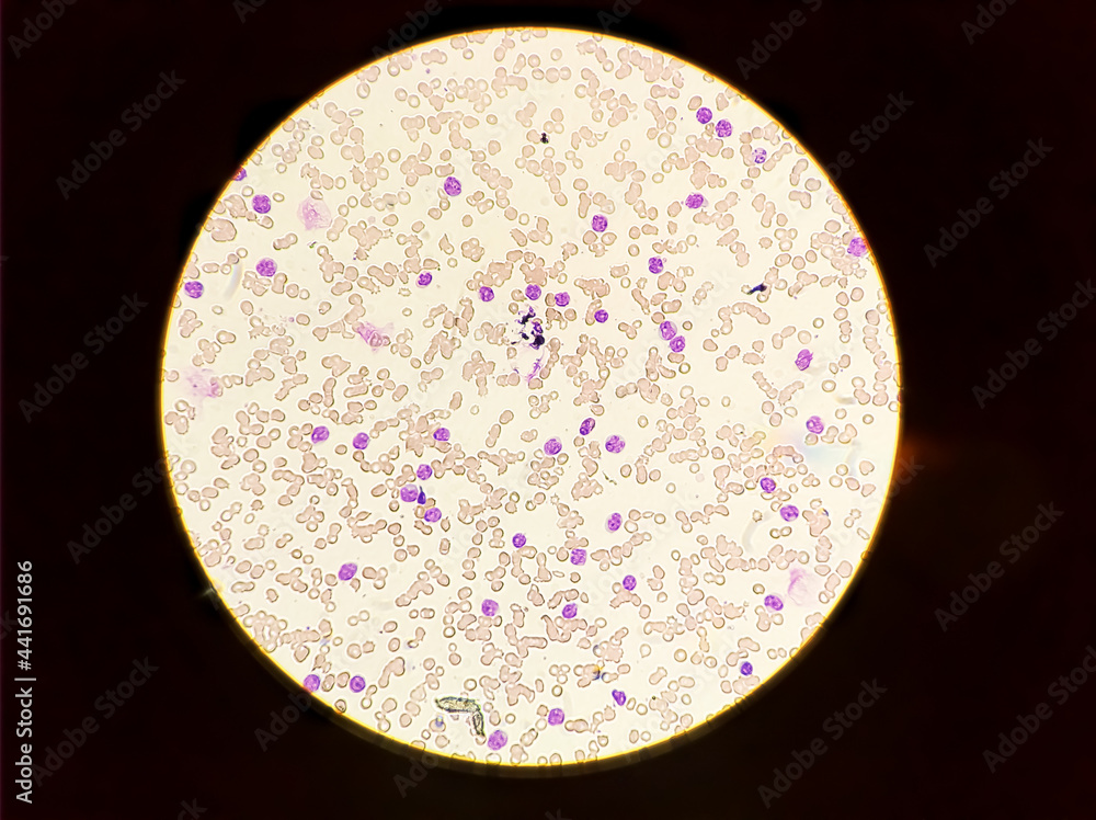 Blood smear under microscopy showing on Adult acute myeloid leukemia ...