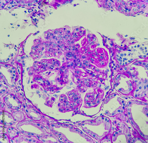 Photo of lupus nephritis, showing wire loop and hyaline thrombi, PAS stain, magnification 400x, photo under microscope photo