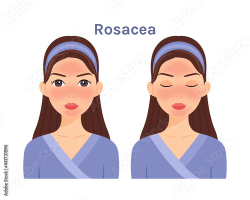 Rosacea. Skin diseases of the Face. Cute Woman with a red cheeks, forehead. Inflammation and allergy. Flat cartoon color style. White background. Illustration for medical and cosmetic design. Vector.