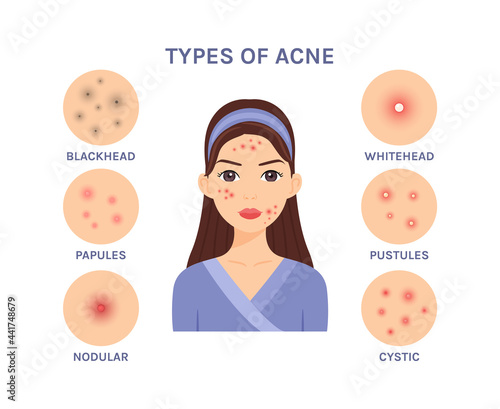 Types of acne,pimples. Isolated cute cartoon brunette girl in a bathrobe, with problem skin, close-up, on a white background. Color cartoon flat illustration. White background. Vector.