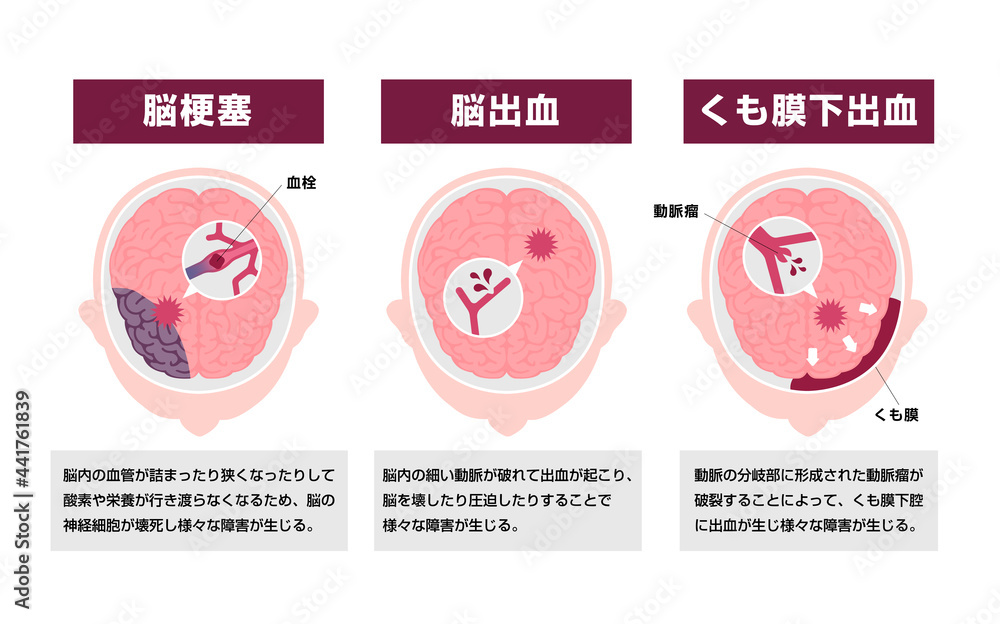 脳卒中 (脳梗塞・脳出血・くも膜下出血) の原因と症状 図解ベクターイラスト Stock ベクター | Adobe Stock