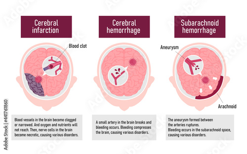Types of human brain stroke vector illustration