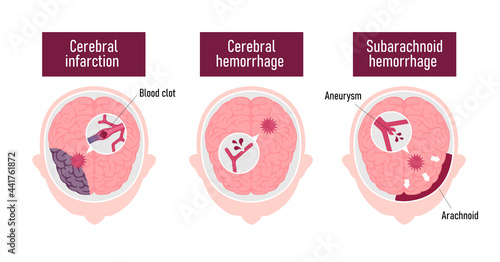 Types of human brain stroke vector illustration photo