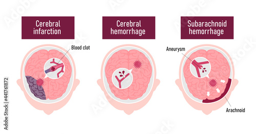 Types of human brain stroke vector illustration