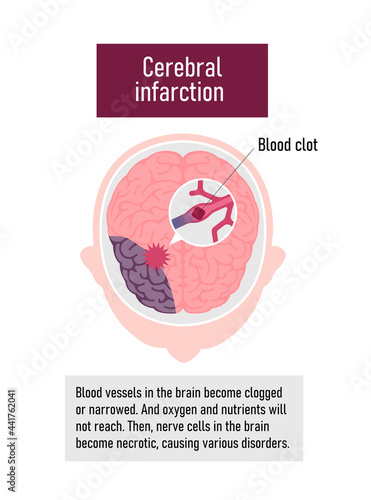 Types of human brain stroke vector illustration | Cerebral infarction