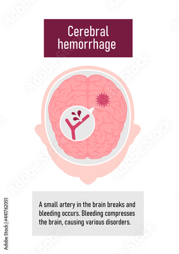 Types of human brain stroke vector illustration | Cerebral hemorrhage
