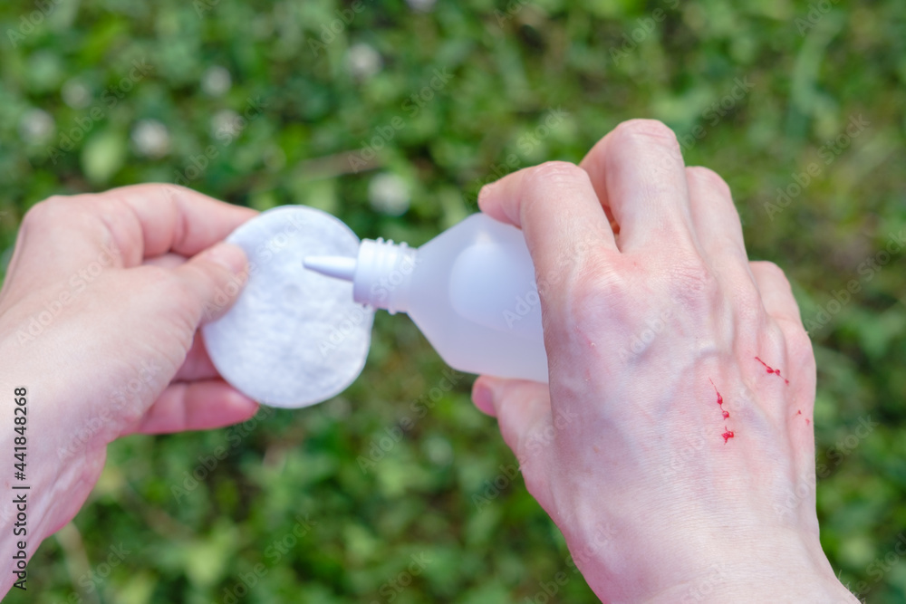 treating redden upper part of hand with cat claw scratches, drops of