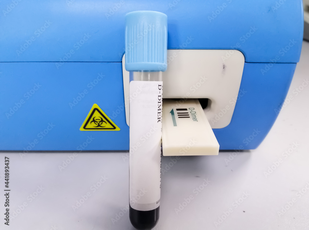 D Dimer test. Corona patient monitoring test in ICU. Close view. deep