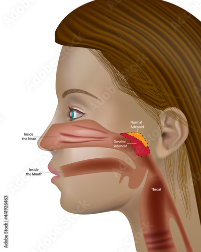 Adenoids, pharyngeal tonsil or nasopharyngeal tonsil (Human Anatomy). Otolaryngology Adenoid hypertrophy photo