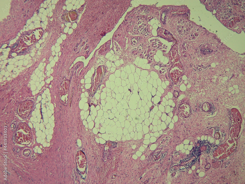 Histopathological image,Orbital hemangioma microscopic high power view. benign tumor,