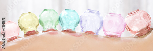 Billede på lærred Vacuum cupping therapy