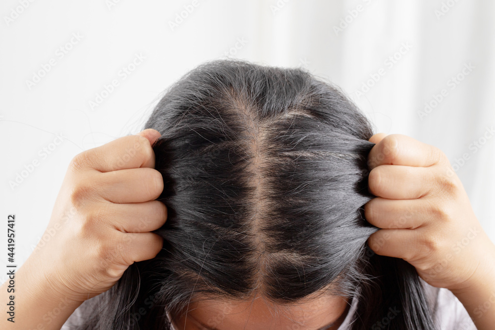 Women allergic to shampoo causing hair loss, baldness, dandruff Women allergic to shampoo causing hair loss, baldness, dandruff