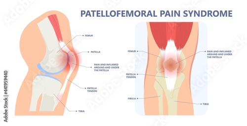 patella pain cap knee tear Torn injury Swelling bone leg exercise muscle jumper's runner's bursitis tendon tibia Anterior Cruciate Ligament ACL sport  femur painful it band rupture Trauma joint cyst photo