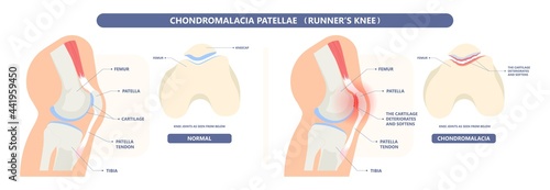 patella pain cap knee tear Torn injury Swelling bone leg exercise muscle jumper's runner's bursitis tendon tibia Anterior Cruciate Ligament ACL sport  femur painful it band rupture Trauma joint cyst
