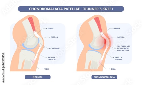 patella pain cap knee tear Torn injury Swelling bone leg exercise muscle jumper's runner's bursitis tendon tibia Anterior Cruciate Ligament ACL sport  femur painful it band rupture Trauma joint cyst