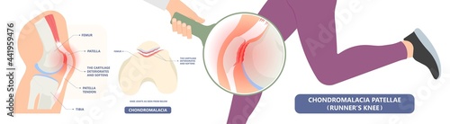 patella pain cap knee tear Torn injury Swelling bone leg exercise muscle jumper's runner's bursitis tendon tibia Anterior Cruciate Ligament ACL sport  femur painful it band rupture Trauma joint cyst