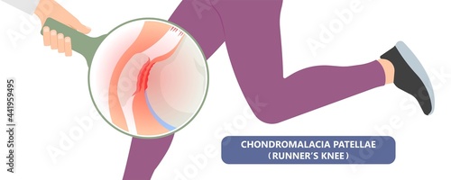 patella pain cap knee tear Torn injury Swelling bone leg exercise muscle jumper's runner's bursitis tendon tibia Anterior Cruciate Ligament ACL sport  femur painful it band rupture Trauma joint cyst