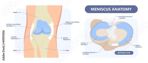 patella pain cap knee tear Torn injury Swelling bone leg exercise muscle jumper's runner's bursitis tendon tibia Anterior Cruciate Ligament ACL sport  femur painful it band rupture Trauma joint cyst