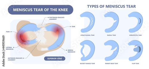 patella pain cap knee tear Torn injury Swelling bone leg exercise muscle jumper's runner's bursitis tendon tibia Anterior Cruciate Ligament ACL sport  femur painful it band rupture Trauma joint cyst