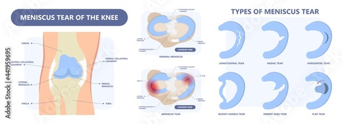 patella pain cap knee tear Torn injury Swelling bone leg exercise muscle jumper's runner's bursitis tendon tibia Anterior Cruciate Ligament ACL sport  femur painful it band rupture Trauma joint cyst