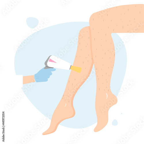 Laser hair removal of the legs and body