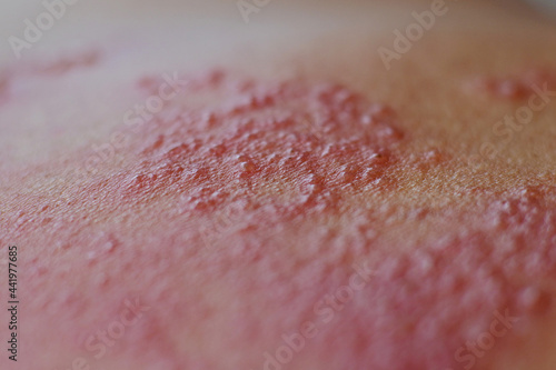 Skin diseases caused by viral infections,shingles