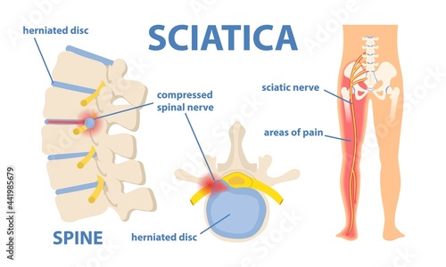 Sciatic nerve pain photo