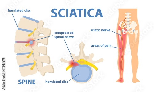 Sciatic nerve pain