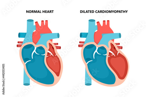 Dilated cardiomyopathy with cross-section view. Human heart muscle diseases. Cardiology concept. photo