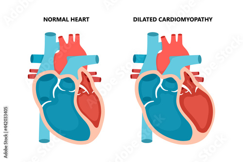 Dilated cardiomyopathy with cross-section view. Human heart muscle diseases. Cardiology concept.