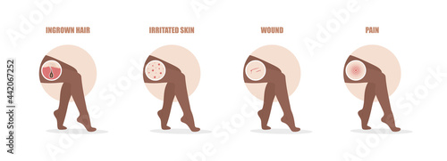 Hair removal problems. Ingrowing hair, irritated skin, wound and pain after epilation. African female legs. Skin care. Vector illustration in flat cartoon style.