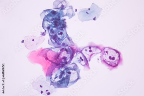 View in microscopic of koilocyte cell criteria of HPV (Human Papilloma virus) infection.Pap smear for woman.Medical background concept.