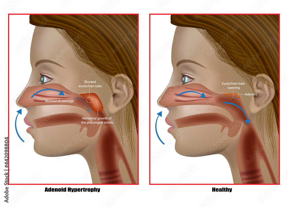 Adenoid hypertrophy, the abnormal growth of the pharyngeal tonsils. Adenoidectomy or Adenoid