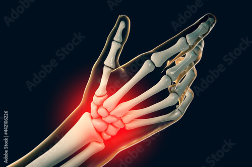 Painful hand, pain in palm or wrist