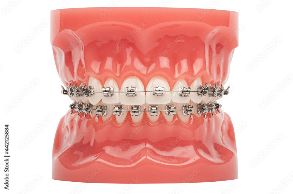 Orthodontic model demonstration teeth model of orthodontic bracket or
