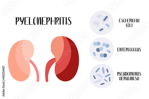 Pyelonephritis. Kidney, urinary system inflammatory disease. Pathogen: Escherichia coli, Enterococcus, Pseudomonas aeruginosa. Urology. Vector flat cartoon illustration