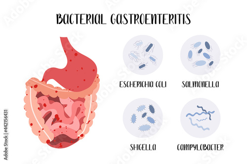 Bacterial gastroenteritis. Stomach, gastric, gut, intestine inflammatory disease. Pathogen: Escherichia coli, Salmonella, Shigella, Campylobacter. Gastroenterology. Vector flat cartoon illustration