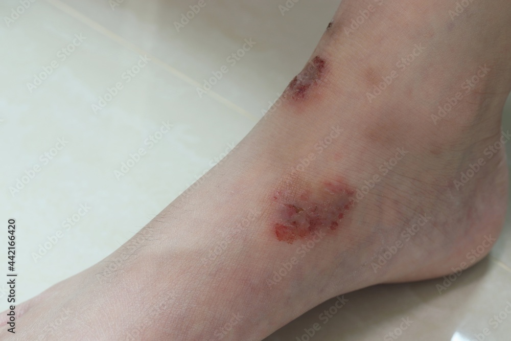 chronic wounds, dermatitis of the feet chronic wounds, dermatitis of the feet