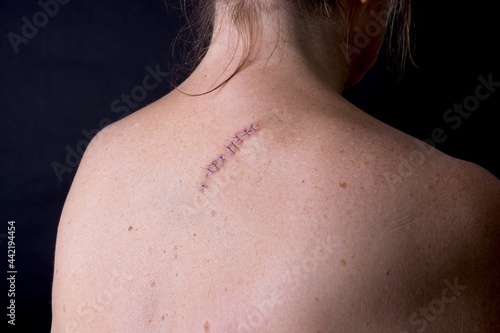 Stitches on the back of a woman after and operation to remove a mole