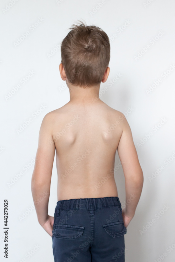 A little boy with a special orthopedic posture corrector on the back to adjust, align the back, posture. Rear view. Copy space A little boy with a special orthopedic posture corrector on the back to adjust, align the back, posture. Rear view. Copy space