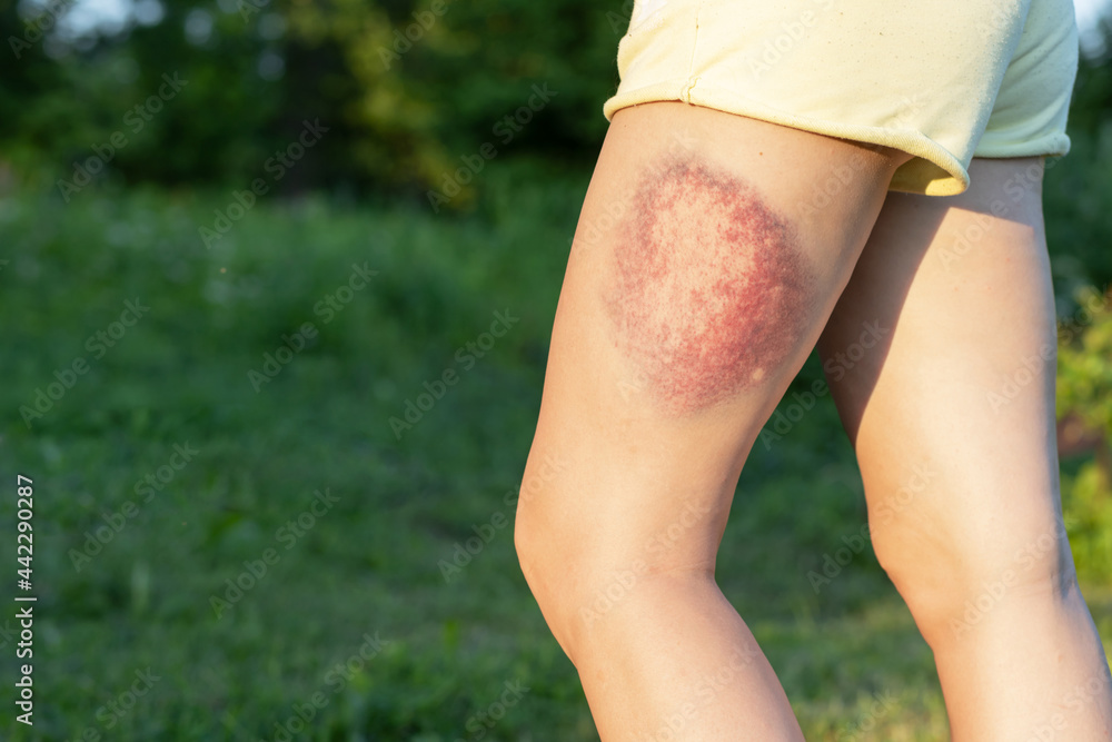female leg with large bruise. woman with hematoma on the thigh. copy space,  text Stock-foto | Adobe Stock