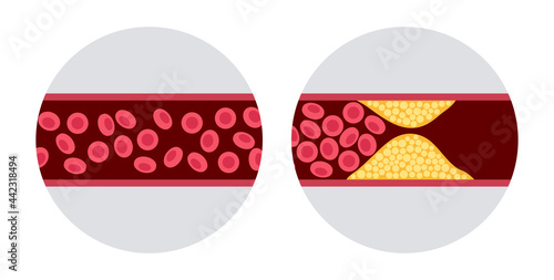 Cholesterol and atherosclerosis