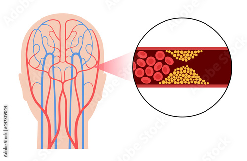 Brain stroke ishemic