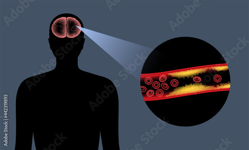 Brain stroke ishemic