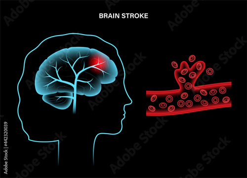 Brain stroke hemorrhagic