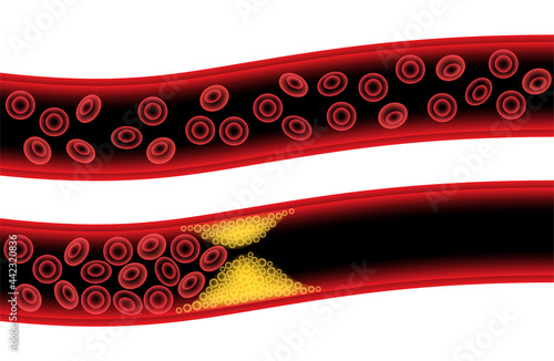 Cholesterol and atherosclerosis